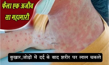 Health News :  फैला एक अजीब सा महामारी, बुखार, जोड़ों में दर्द के बाद शरीर पर लाल चकत्ते
