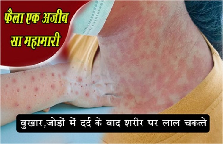 Health News :  फैला एक अजीब सा महामारी, बुखार, जोड़ों में दर्द के बाद शरीर पर लाल चकत्ते