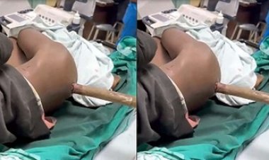 मजदूर के पेट में घुसा 15 फीट लंबा बांस, OT में डॉक्टरों ने बुलाया कारपेंटर,  मिस्त्री की मदद से डॉक्टरों ने ऑपरेशन कर बचाई जान