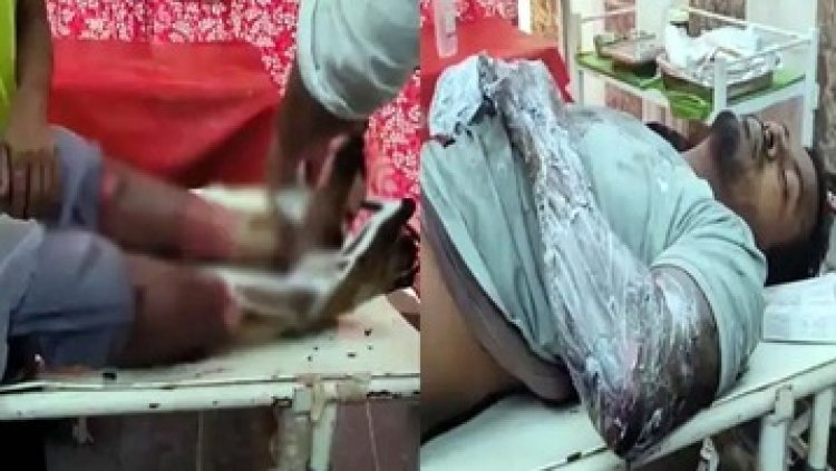 मालगाड़ी से कोयला चोरी करते समय हाईवोल्टेज तार की चपेट में आया युवक, हाथ और पैर झुलसे, अस्पताल में भर्ती, हालत नाजुक