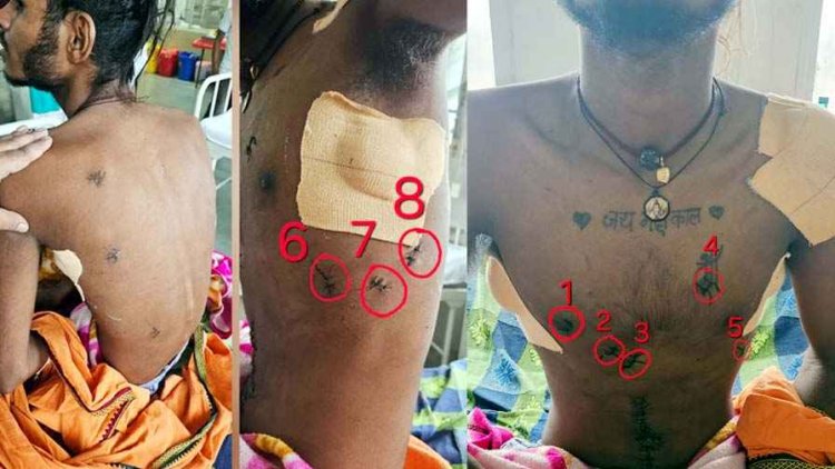 17 बार चाकू से वार, फटा फेफड़ा-कटी आंत, मौत के दरवाजे से लौटा 19 साल का युवक, डॉक्टरों ने लिखी जिंदगी की नई कहानी