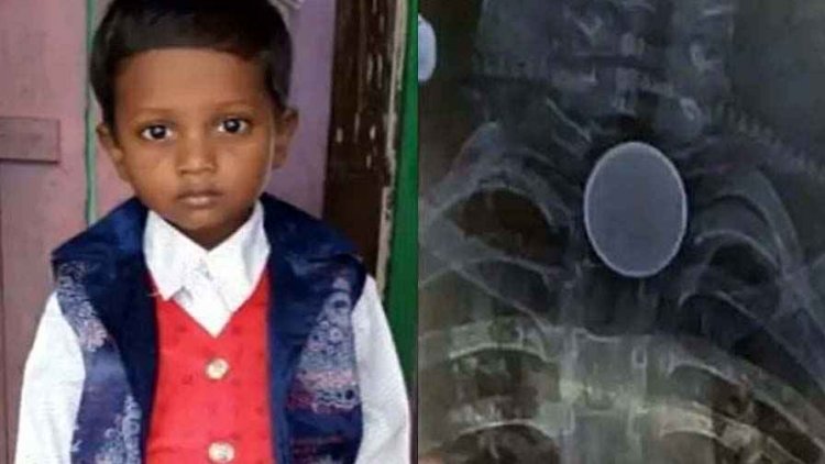 खेल-खेल में मासूम बच्चे ने निगला सिक्का, डॉक्टर बोले- यहां इलाज संभव नहीं, उपचार से पहले ही बुझ गया चिराग, सीने में फंसने से मौत