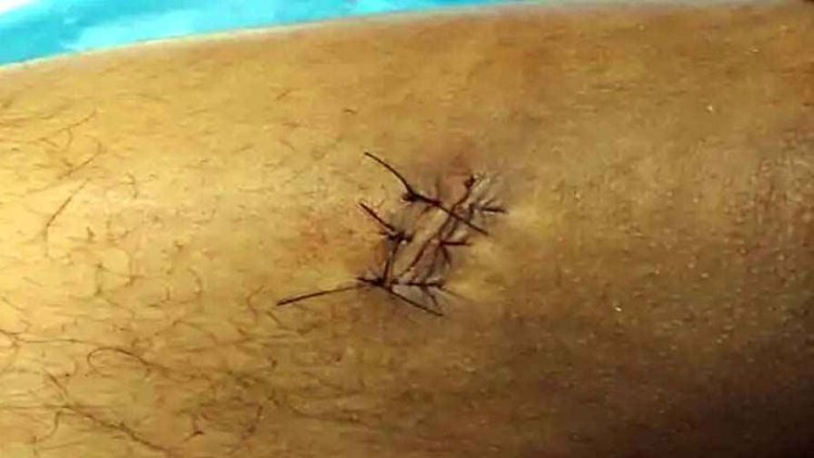 युवती को लेकर जमकर विवाद, युवक को मारा चाकू, पैर में लगे टाके, अस्पताल में भर्ती, रायपुर पुलिस ने आरोपी राहुल को किया गिरफ्तार