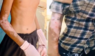 हॉस्टल में खौलती दाल से जले छात्र, दर्द से तड़पते रहे, हाथ-पैर और चेहरे की चमड़ियां छिलीं, परीक्षा भी छूटी, वार्डन ने लगाई ड्यूटी!, सुरक्षा व्यवस्था पर गंभीर सवाल